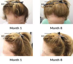female pattern hair loss the belgravia centre 443123
