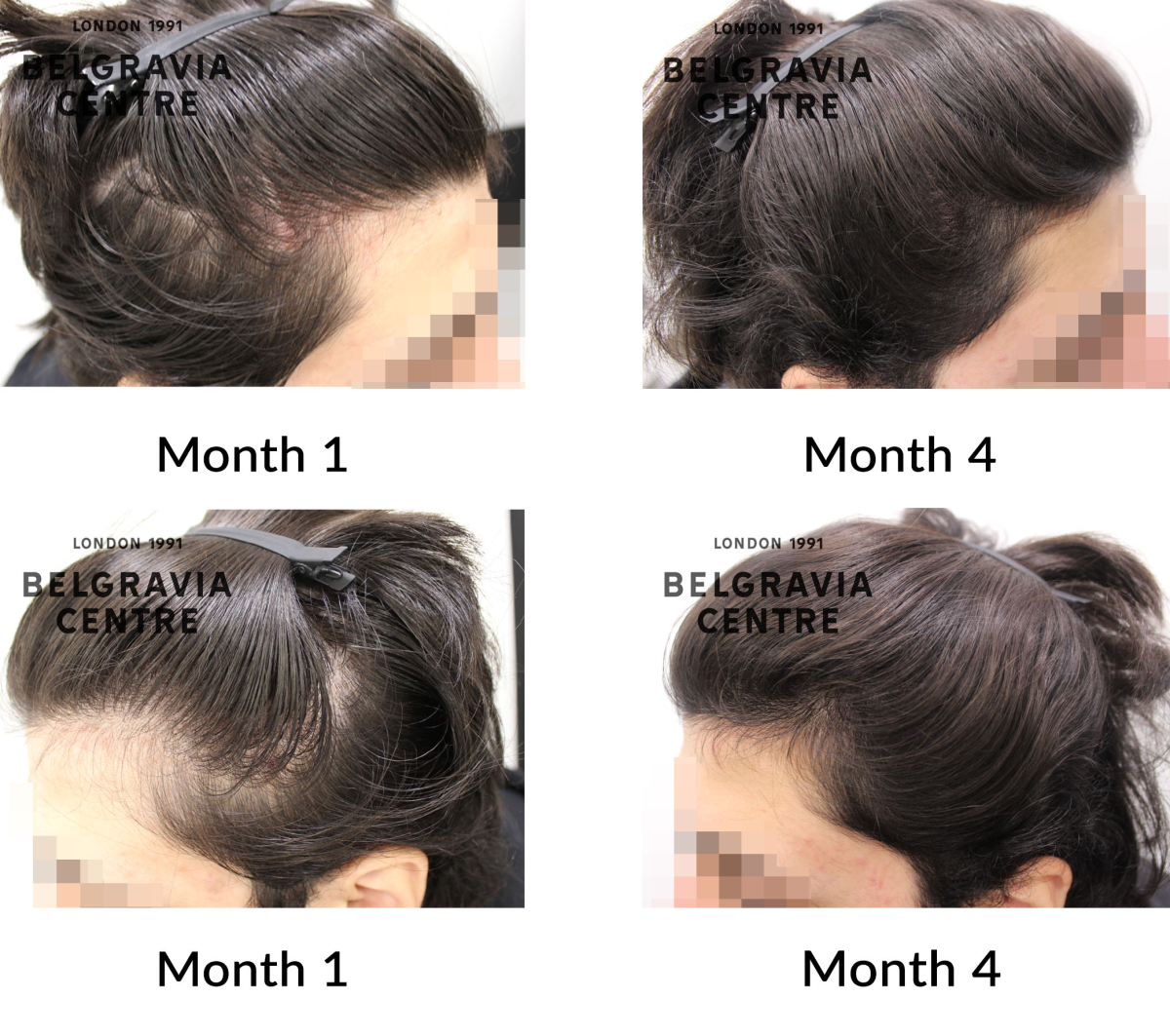 male pattern hair loss the belgravia centre 456726