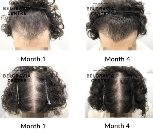 male pattern hair loss the belgravia centre 466625