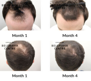 male pattern hair loss the belgravia centre 441451