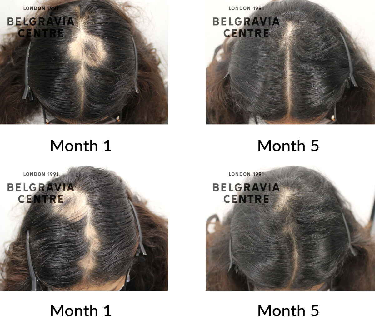alopecia areata the belgravia centre 434748