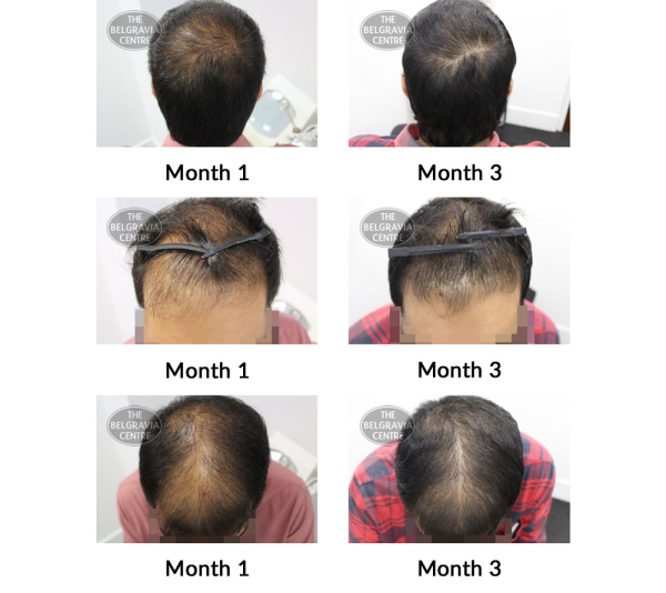 male pattern hair loss the belgravia centre 386042 04 11 2019
