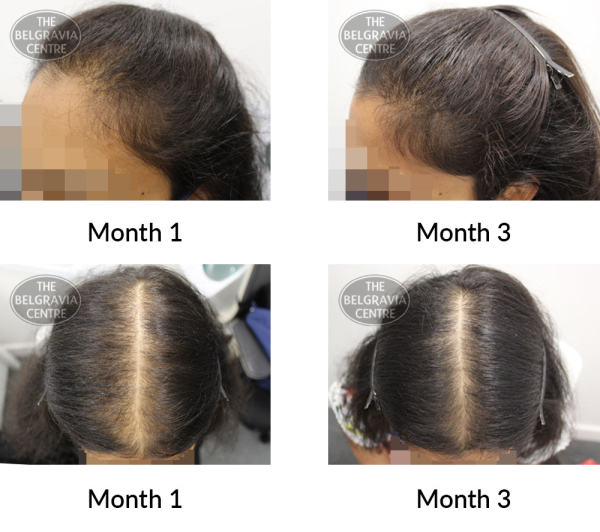 female pattern hair loss the belgravia centre 420201 21 07 2021