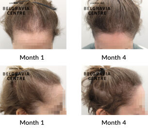 female pattern hair loss the belgravia centre 446621