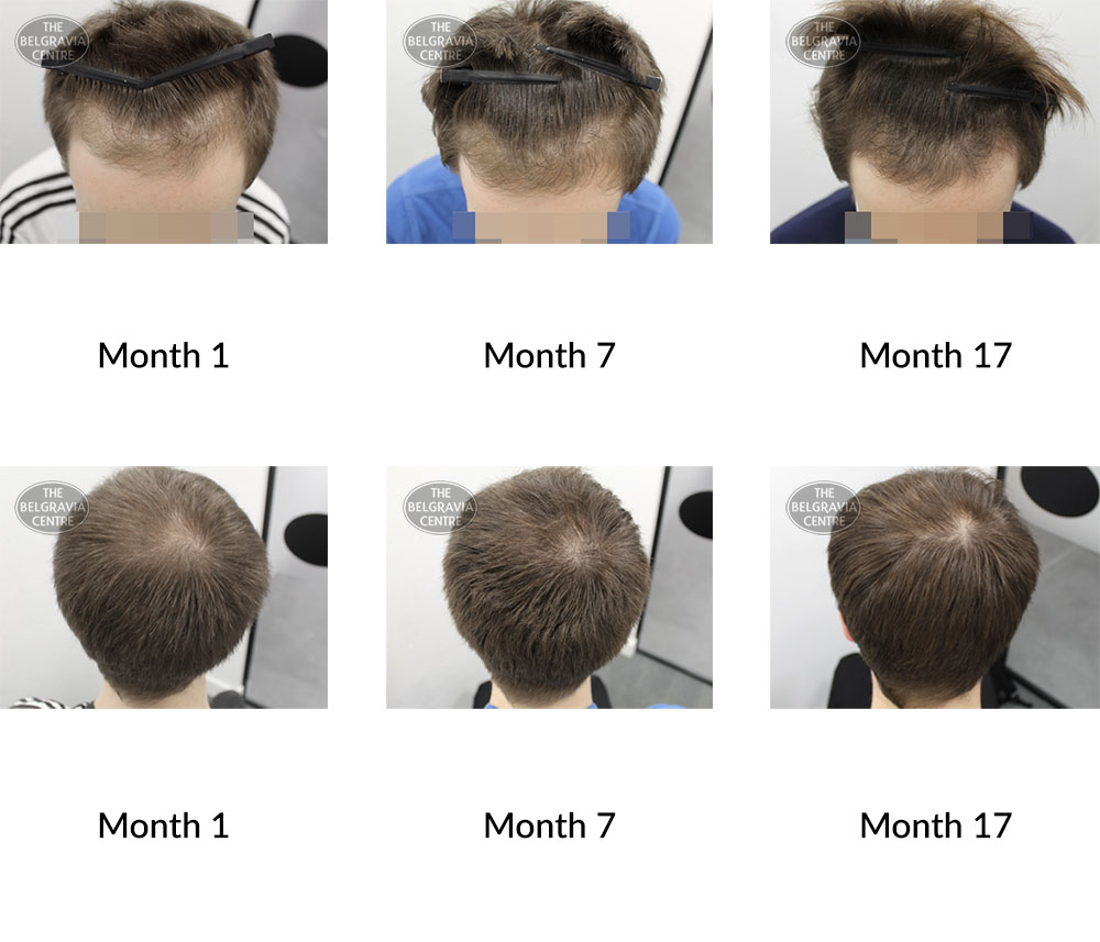 male pattern hair loss the belgravia centre 386826 15 01 2021