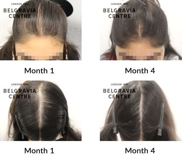 female pattern hair loss the belgravia centre 437566
