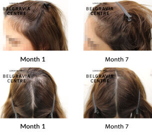 diffuse hair loss and female pattern hair loss the belgravia centre 437291