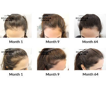 alert female pattern hair loss the belgravia centre 317879