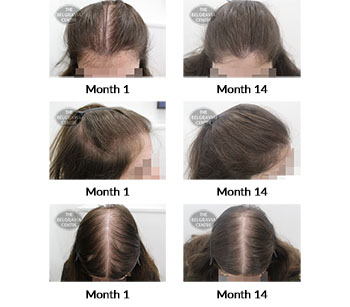 alert female pattern hair loss the belgravia centre 397983 18 05 2021