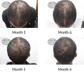 alert male pattern hair loss the belgravia centre 411048 27 04 2021