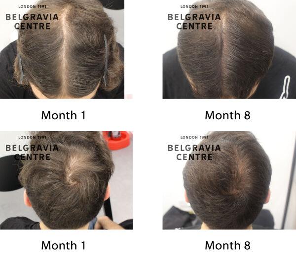 male pattern hair loss the belgravia centre 436734