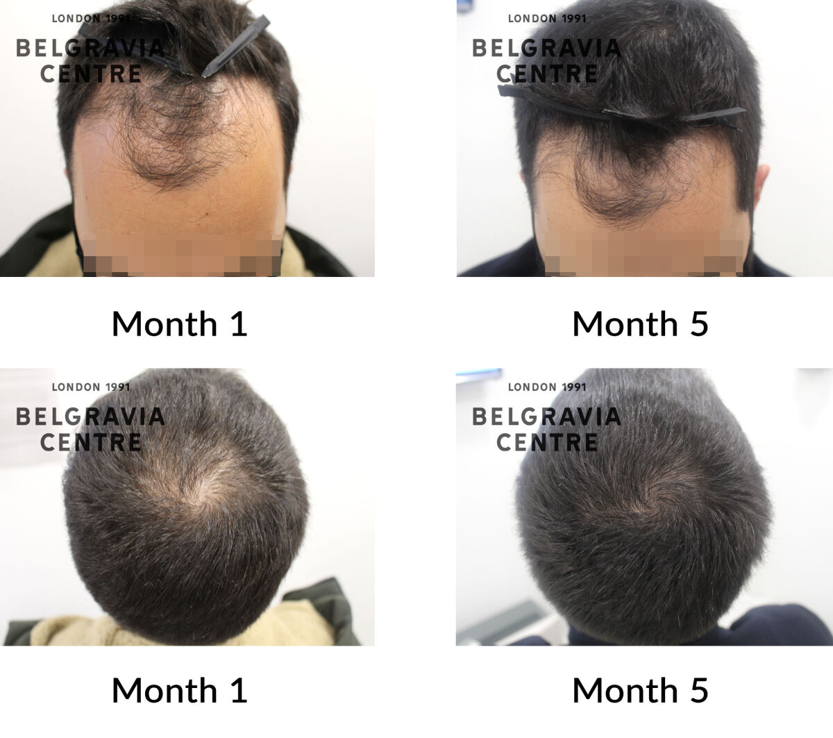 male pattern hair loss the belgravia centre 429901