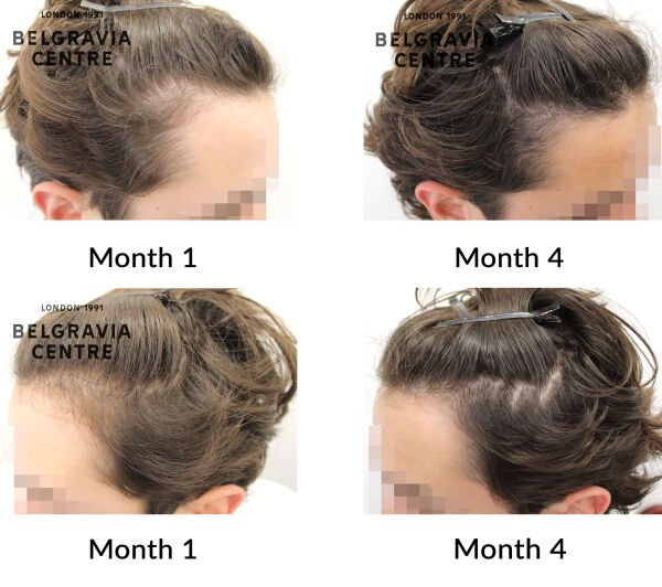 male pattern hair loss the belgravia centre 452297