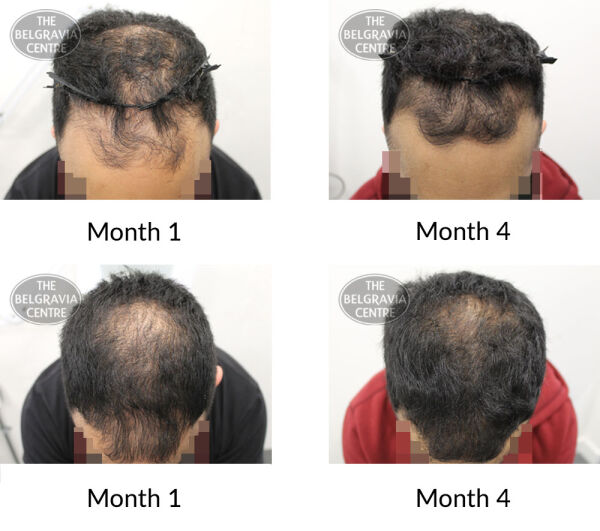male pattern hair loss the belgravia centre 399198 25 11 21