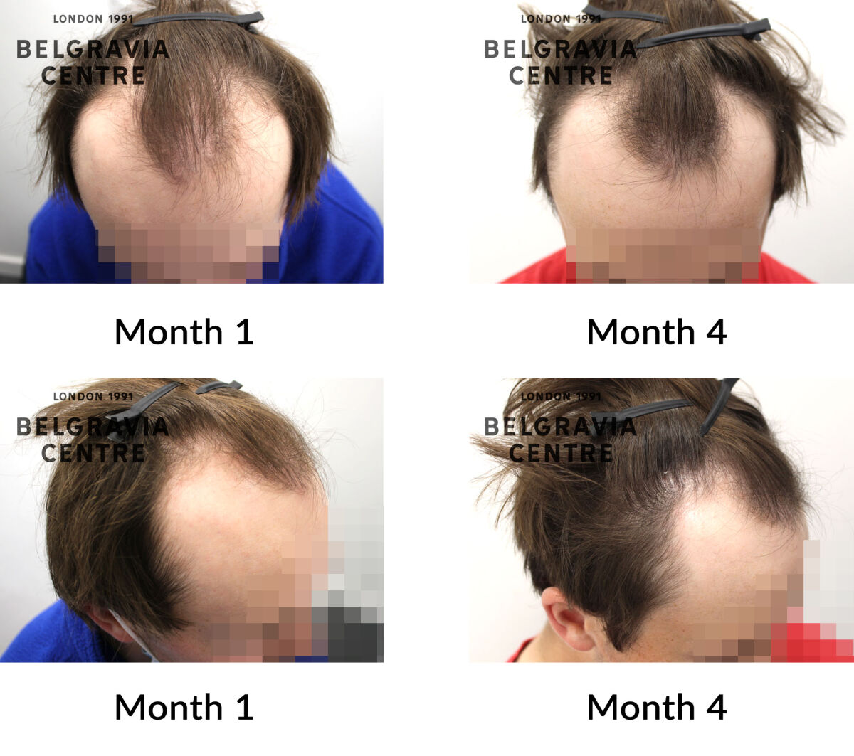 male pattern hair loss the belgravia centre 432483