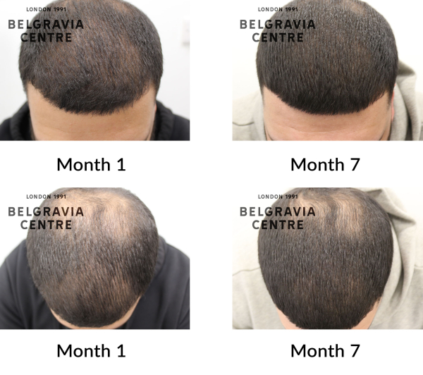 male pattern hair loss the belgravia centre 441665