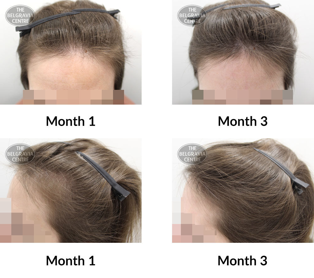female pattern hair loss the belgravia centre 392694 14 04 2020 DRAFT