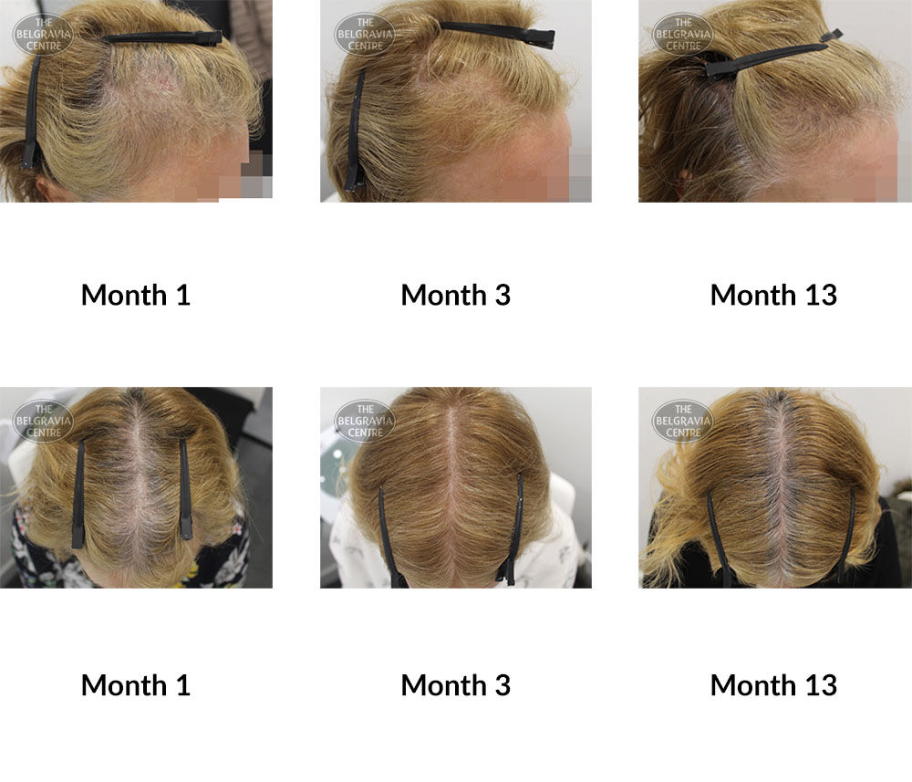 female pattern hair loss the belgravia centre 106302 30 04 2020