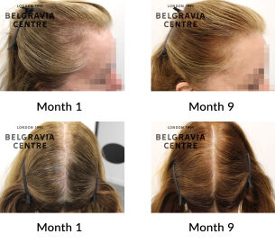 female pattern hair loss the belgravia centre 426395