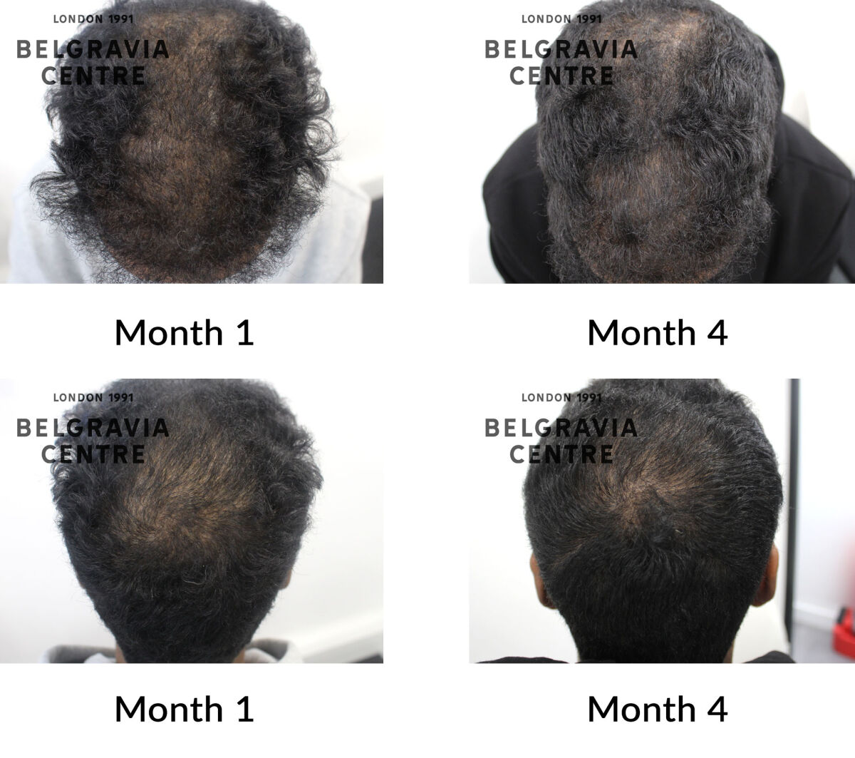 male pattern hair loss the belgravia centre 368133