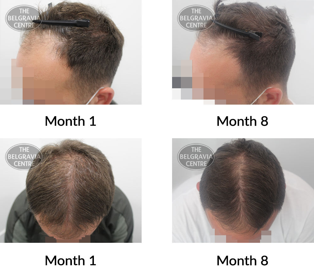 male pattern hair loss the belgravia centre 409686 02 06 2021