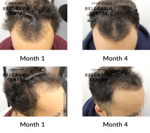 male pattern hair loss the belgravia centre 445916