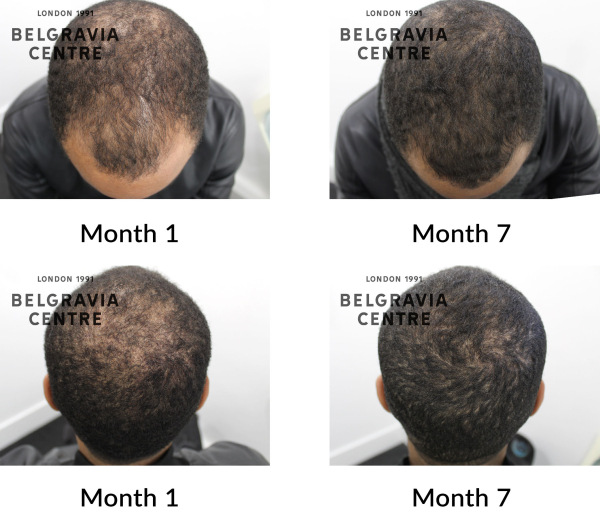 male pattern hair loss the belgravia centre 350795