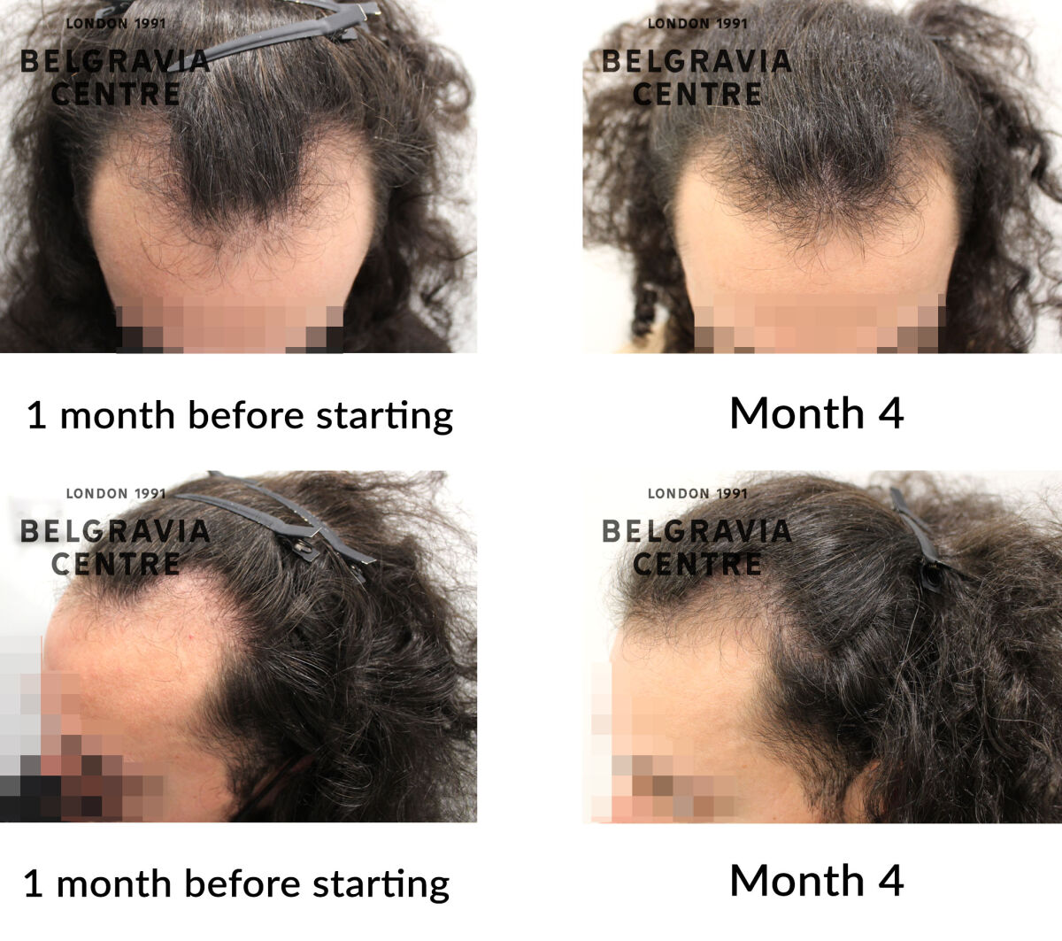 male pattern hair loss the belgravia centre 435286