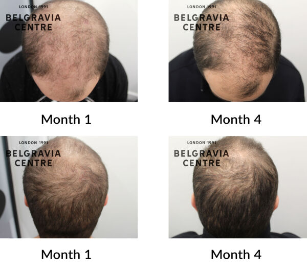 male pattern hair loss the belgravia centre 448066