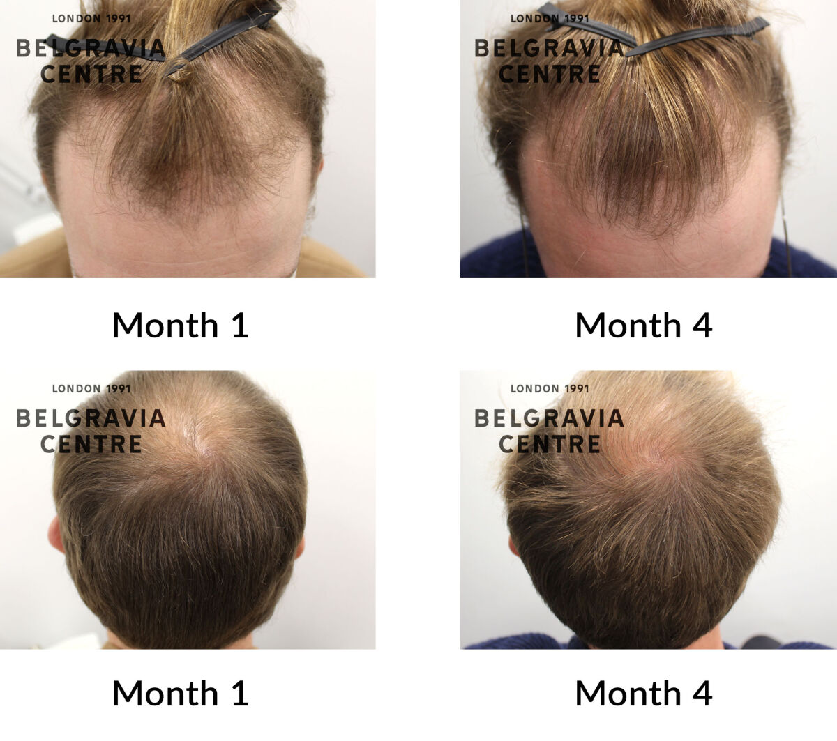 male pattern hair loss the belgravia centre 436461