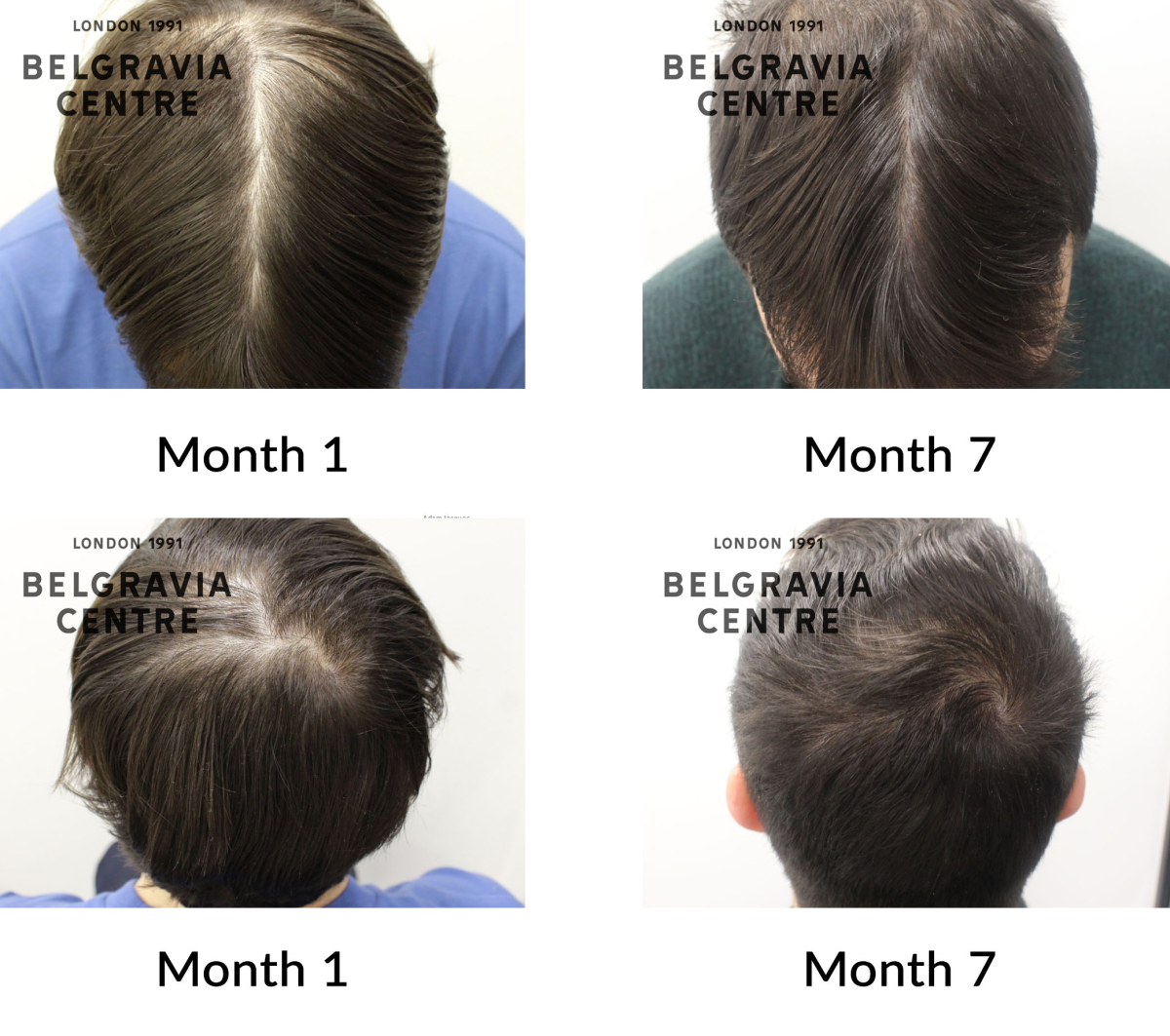 male pattern hair loss the belgravia centre 441486