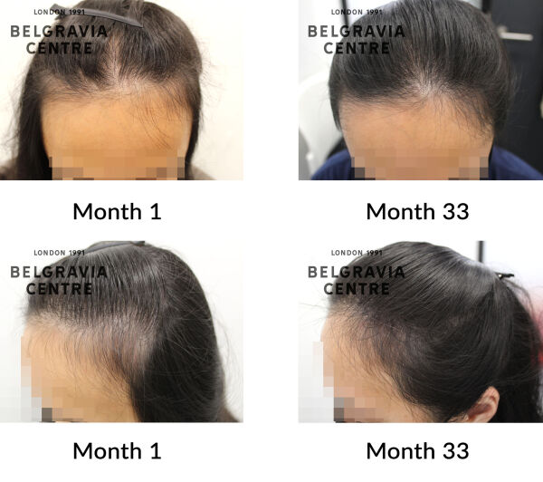 female pattern hair loss the belgravia centre 389419