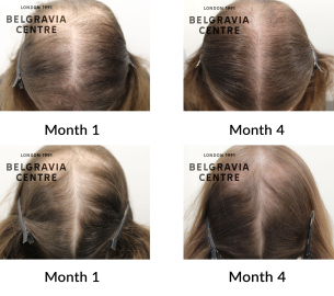 female pattern hair loss the belgravia centre 449077