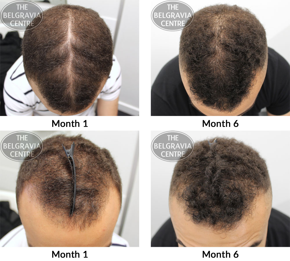 male pattern hair loss the belgravia centre ma 12 12 2018