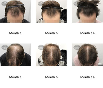 alert male pattern hair loss the belgravia centre 387837 02 02 2021