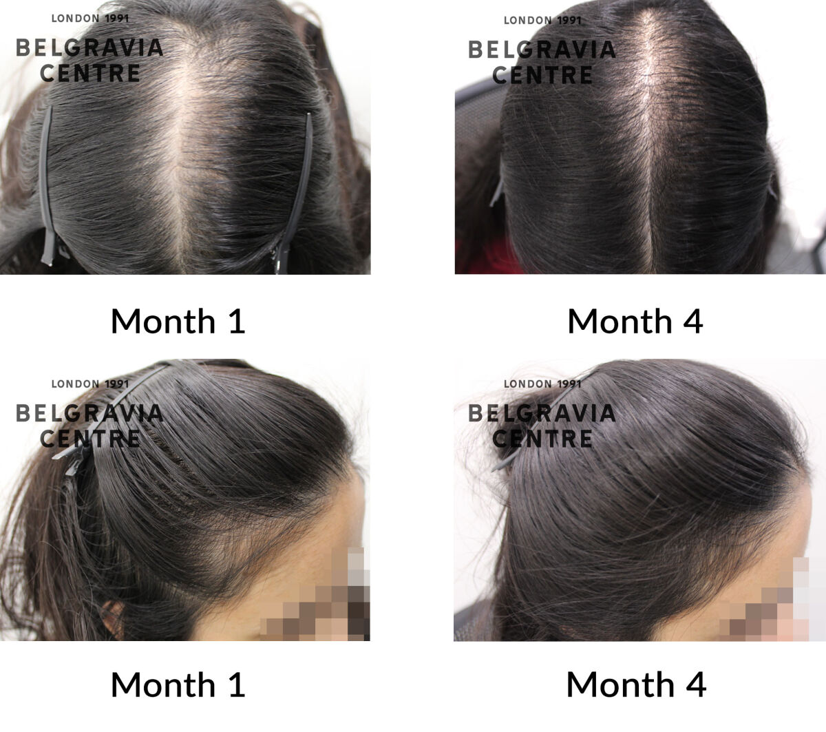 female pattern hair loss and diffuse thinning the belgravia centre 457855