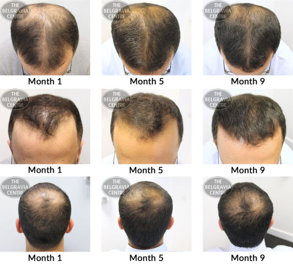 male pattern hair loss the belgravia centre sh 20 12 2018