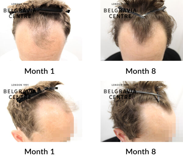 male pattern hair loss the belgravia centre 441800