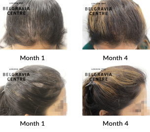 female pattern hair loss the belgravia centre 451512