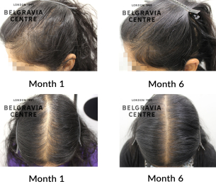 female pattern hair loss the belgravia centre 455391