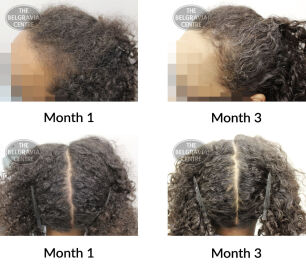 telogen effluvium and female pattern hair loss the belgravia centre 423109 19 08 2021