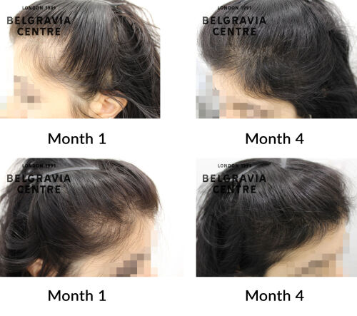female pattern hair loss the belgravia centre 443594