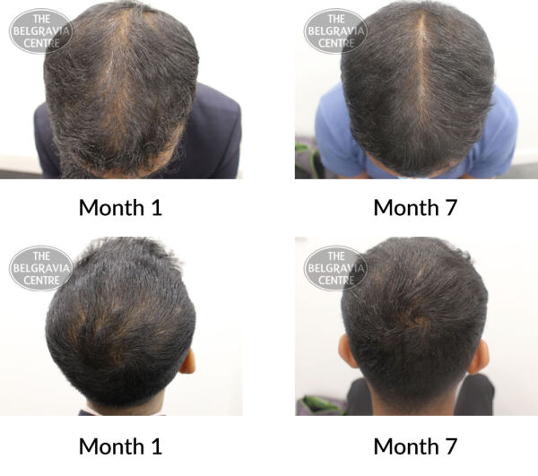 male pattern hair loss the belgravia centre 395119 04 08 2020