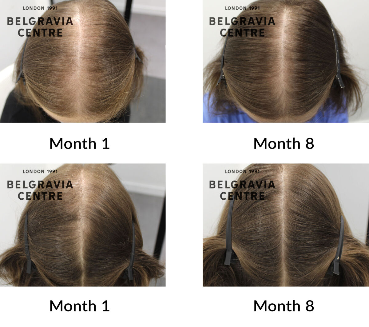female pattern hair loss the belgravia centre 429279