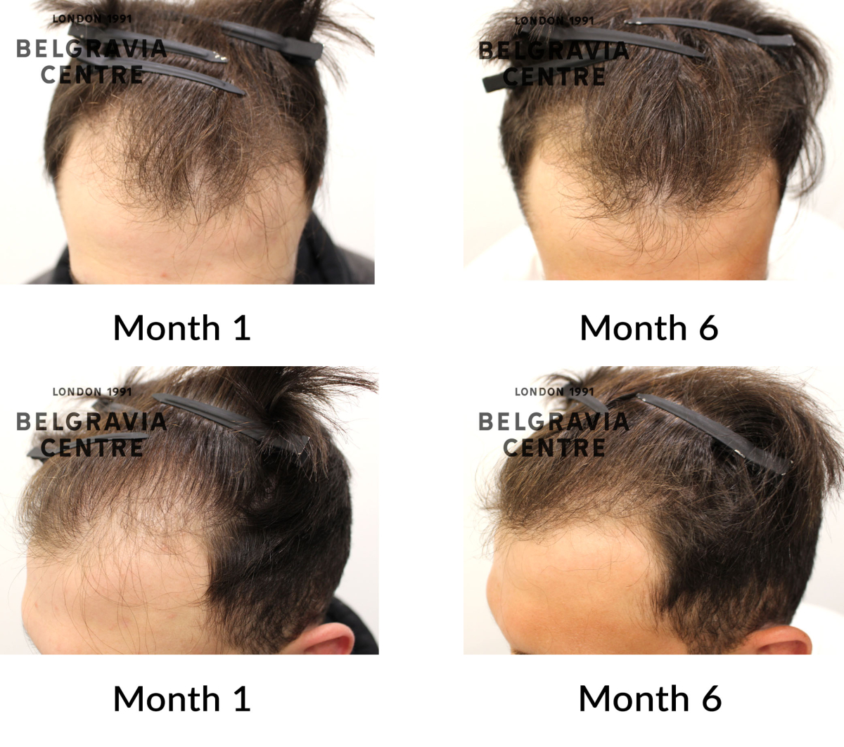 male pattern hair loss the belgravia centre 443860