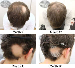 Alopecia Areata The Belgravia Centre MB 16 12