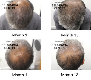 male pattern hair loss the belgravia centre 447836