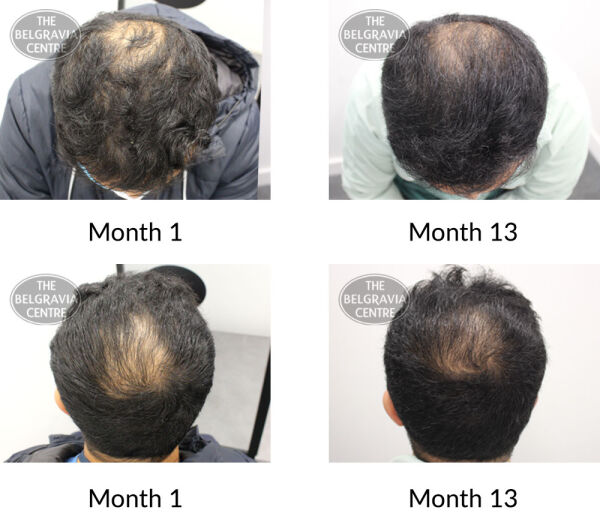 male pattern hair loss the belgravia centre 410982 151121