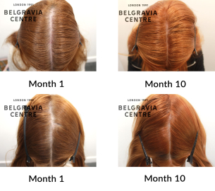 telogen effluvium chronic and female pattern hair loss the belgravia centre 451311