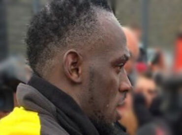 Usain Bolt hairline hair loss